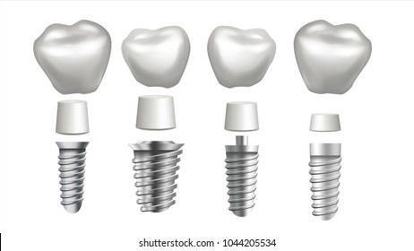 Dental Implant Set Vector. Implant Structure. Crown, Abutment, Screw. Care, Stomatology. Realistic Isolated Illustration