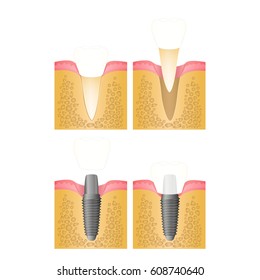 Dental implant, steps for placement of the implant