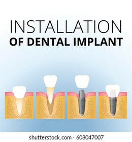 Dental implant, steps for placement of the implant, implantation of the tooth