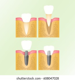 Dental implant, steps for placement of the implant, implantation of the tooth