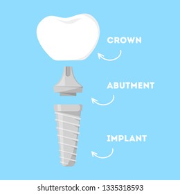 Dental implant structure. Artificial tooth parts. Implant, abutment and realistic crown. Dental restoration. Isolated vector illustration in cartoon style