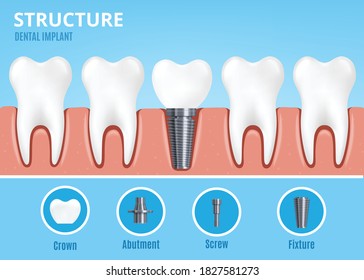 Dental implant structure. Crown and abutment with screw and fixture. Dentist professional equipment for work to implement, flat cartoon vector illustration