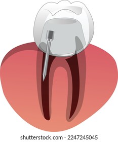 estructura de implantes dentales Diseño 2