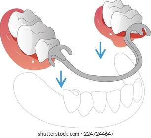 dental implant structure Design 4