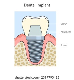 Dental implant structure diagram hand drawn schematic vector illustration. Medical science educational illustration