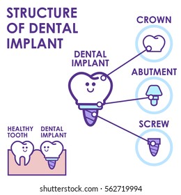 Dental implant structure educative info graphic poster with molar replacement end healthy tools models vector illustration in cartoon style.