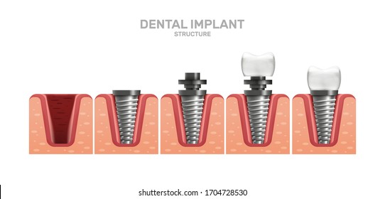 Dental implant structure and full placement steps in realistic style. Сrown, abutment, screw. Gingiva. Stomatology dentistry. Vector 3d illustration.