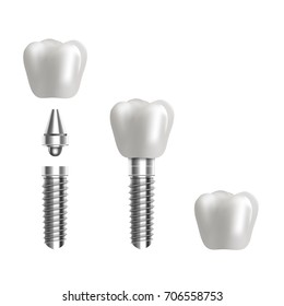 Dental implant structure illustration. 3d realistic vector background.