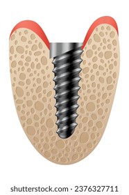 Dental implant structure. Medical educative infographic poster. Teeth implant, realistic vector design of dentistry. Implant screw, healthcare, dentist and orthodontist treatment