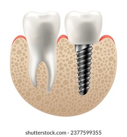 Dental implant structure. Medical educative infographic poster. Teeth implant, realistic vector design of dentistry. Implant screw, healthcare, dentist and orthodontist treatment