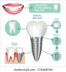 Dental implant structure medical pictorial educative infographic poster with molar replacement end healthy tools models vector illustration