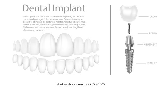 Dental implant structure medical pictorial educative infographic poster with molar replacement end healthy tools models vector illustration.