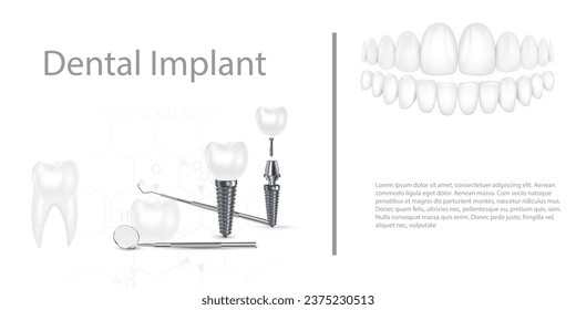 Dental implant structure medical pictorial educative infographic poster with molar replacement end healthy tools models vector illustration.