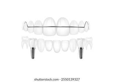 Implante dentário estrutura médica pictórico educativo infográfico cartaz com substituição molar fim ferramentas saudáveis modelos ilustração vetorial.