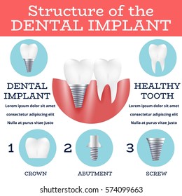 Dental implant structure medical pictorial educative infographic poster with molar replacement end healthy tools models vector illustration