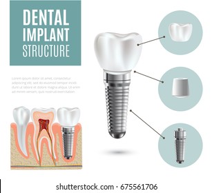 Dental implant structure medical pictorial educative infographic poster