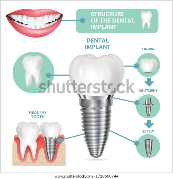 Dental Implant Structure Medical Pictorial Educative Stock Vector ...