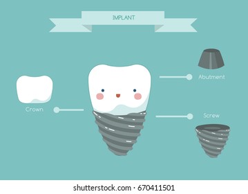  Dental implant structure medical ,teeth and tooth concept of dental