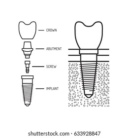 Dental implant and its structure is painted in a flat linear style, vector illustration isolated on white background, medical illustration