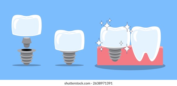 Dental implant structure and prodecure . Tooth cartoon illustration . Isolated on blue background . Vector .