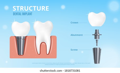 Dental implant structure - realistic poster mockup with real tooth and ceramic crown on metal screw and abutment inside gums. Vector illustration.