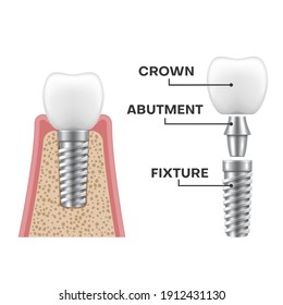 Dental implant structure realistic schematic. Implantation sequence. Fixture, abutment, crown. Orthopedic treatment modern method. Vector stomatological illustration isolated on white background.