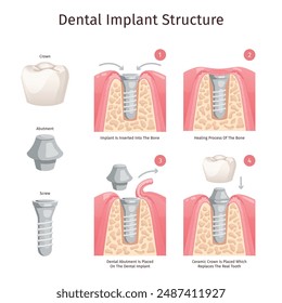 Dental implant structure. Tooth implantation procedure teeth replacement implants prosthesis parts abutment crown fixture screw dentistry medical diagram swanky vector illustration