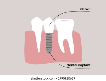 A dental implant technology scheme, white teeth in a gum, orthodontist theme