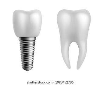 Dental implant and teeth. Realistic orthodontic elements. Human white enamel tooth crown, dentistry implantation technology, stomatology clinic object, vector 3d isolated illustration