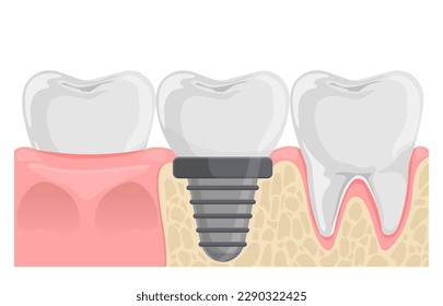 Dental implant Tooth replacement. Teeth in gum anatomy. Flat vector illustration isolated on white background.
