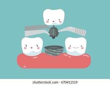  Dental implant tooth ,teeth and tooth concept of dental