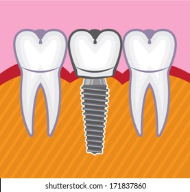 Dental implant vector