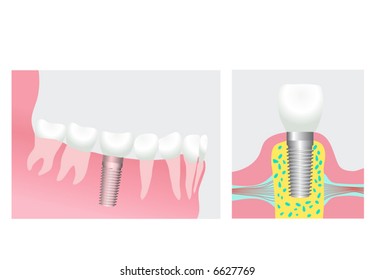 dental implant (vector)