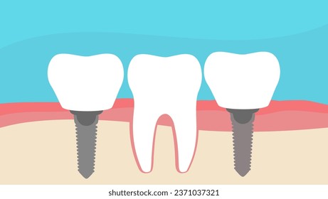 implante dental, ilustración de un vector de material plano