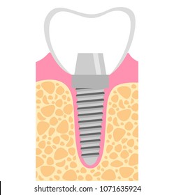 Dental implant Vector Illustration
