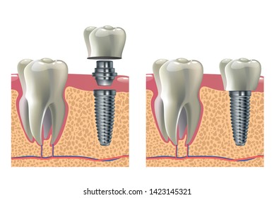 Dental implant vector illustration - humant teeth medical infographic poster
