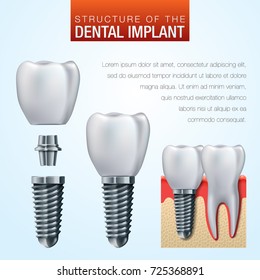 Dental implant vector illustration - humant teeth medical infographic poster