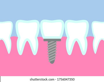 Dental implant vector illustration. Metal or titanium tooth pin installation. Orthodontic surgery. Replacement crown on teeth. Stomatology health care. Medical theme infographic. 