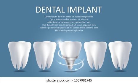 Dental implant vector medical poster banner template. Realistic human teeth and metal screw with crown attached between them. Dental surgery, tooth replacement concept.