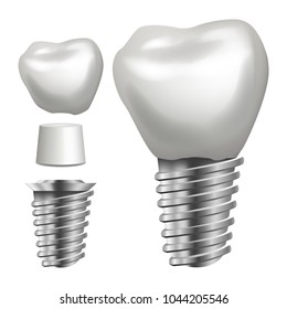 Dental Implant Vector. Implant Structure. Crown, Abutment, Screw. Realistic Isolated Illustration