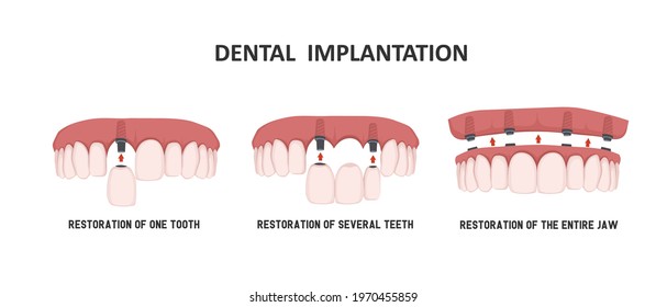 Dental  implantation. Anterior teeth implantation. Implantation of one, two or more teeth