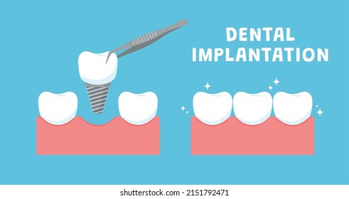 Dental implantation banner or poster layout. Banner backdrop for dentistry services and implantology, flat vector illustration isolated on blue background.