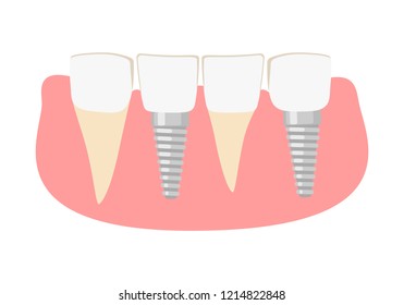 Dental implantation. Healthy human teeth and Dental implant. dental implant. Vector illustration