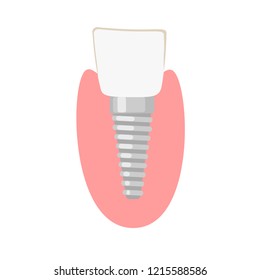 Dental implantation. Healthy human teeth and Dental implant. dental implant. Vector illustration
