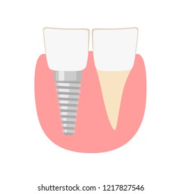 Dental implantation. Healthy human teeth and Dental implant. dental implant. Vector illustration