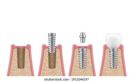Dental implantation process steps, timeline realistic set. Damaged tooth removal, placement implant, abutment, crown. Artificial teeth installation. Vector  implantant isolated on white background.