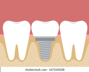 Dental implantation. A prosthesis among ordinary teeth. Vector illustration