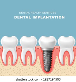 Dental implantation - row of teeth in gum with implant, vector