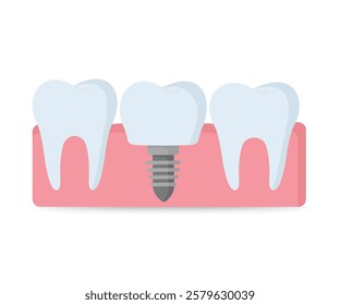 Dental implantation, tooth restoration, icon on a white background. Vector illustration stock illustration