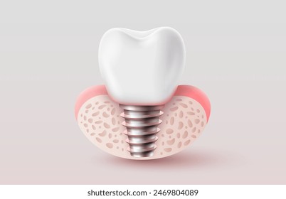 Dental implantation, tooth restoration, symbol on a white background. Vector illustration